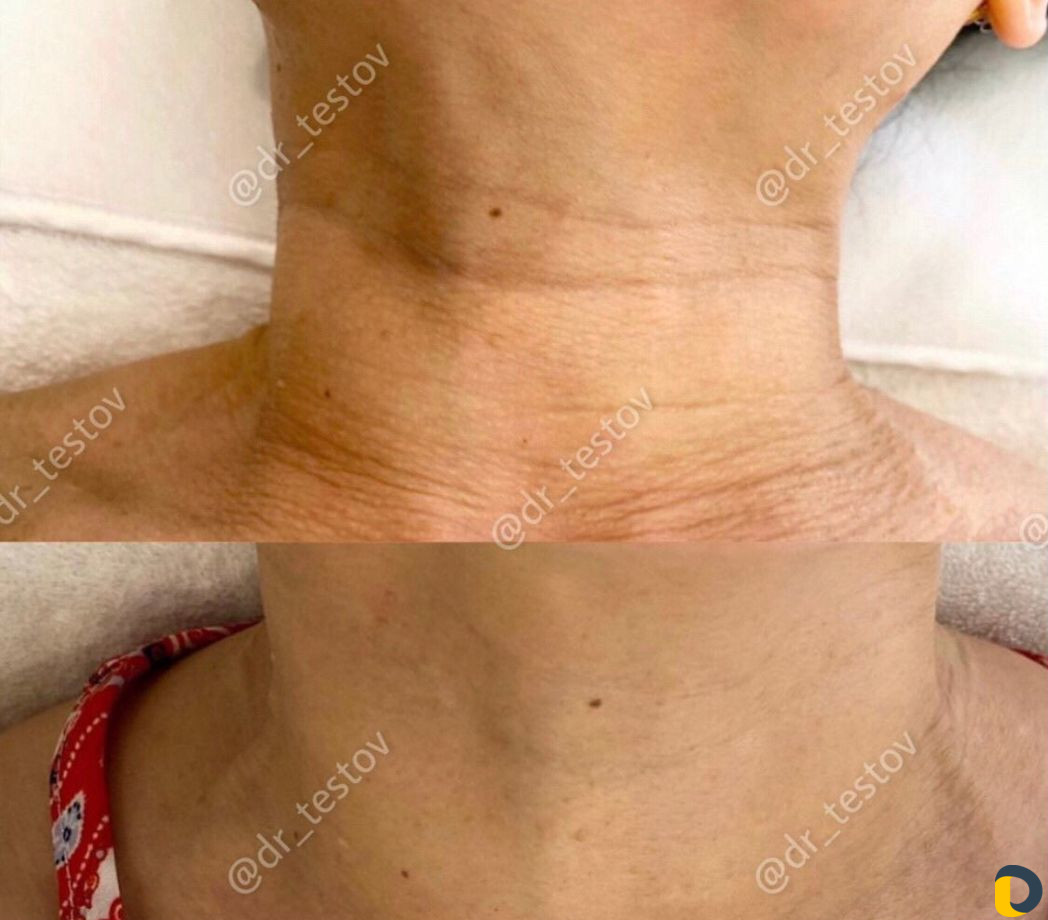 Фейслифтинг