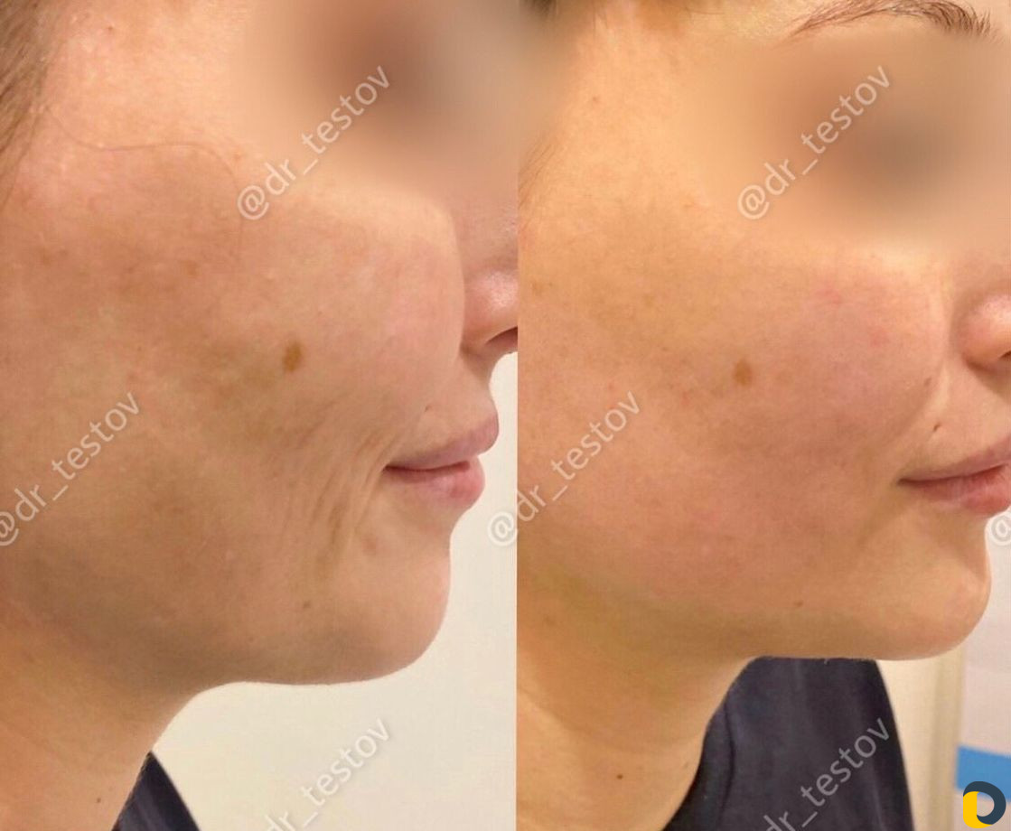 Фейслифтинг