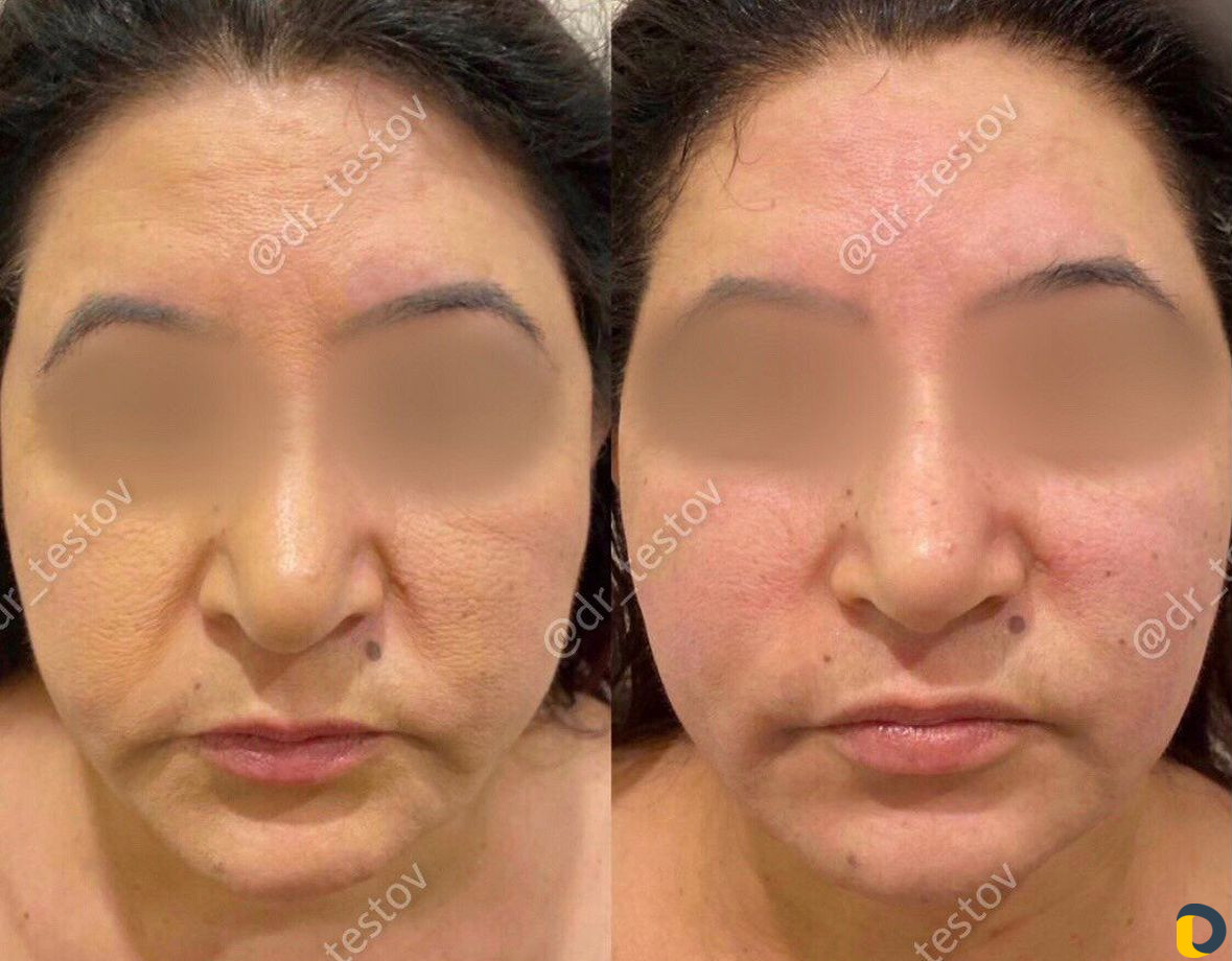 Фейслифтинг