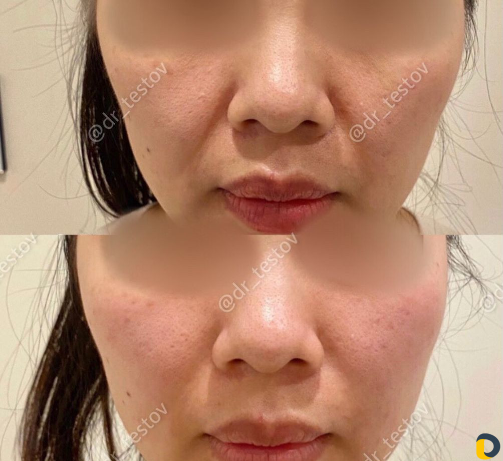 Фейслифтинг