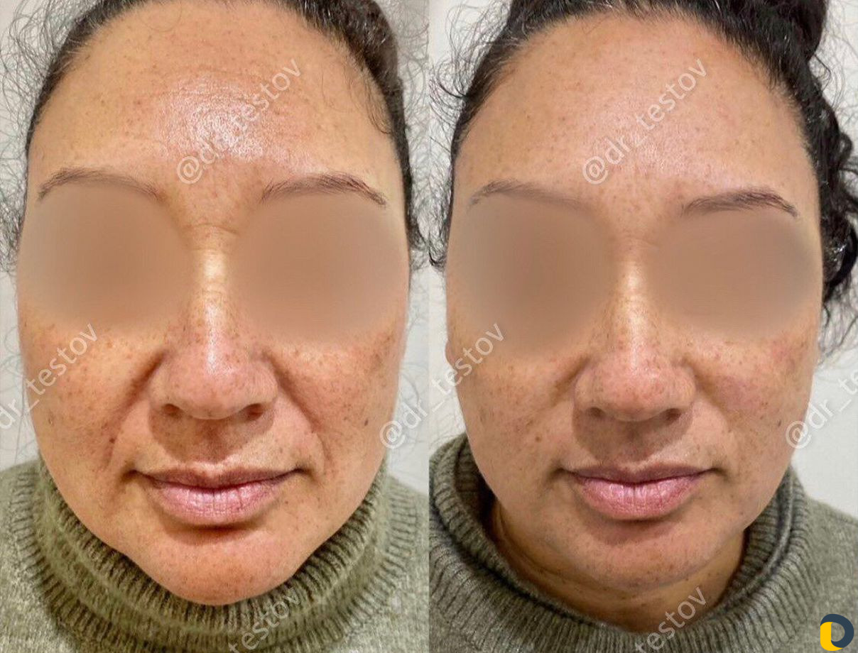 Фейслифтинг