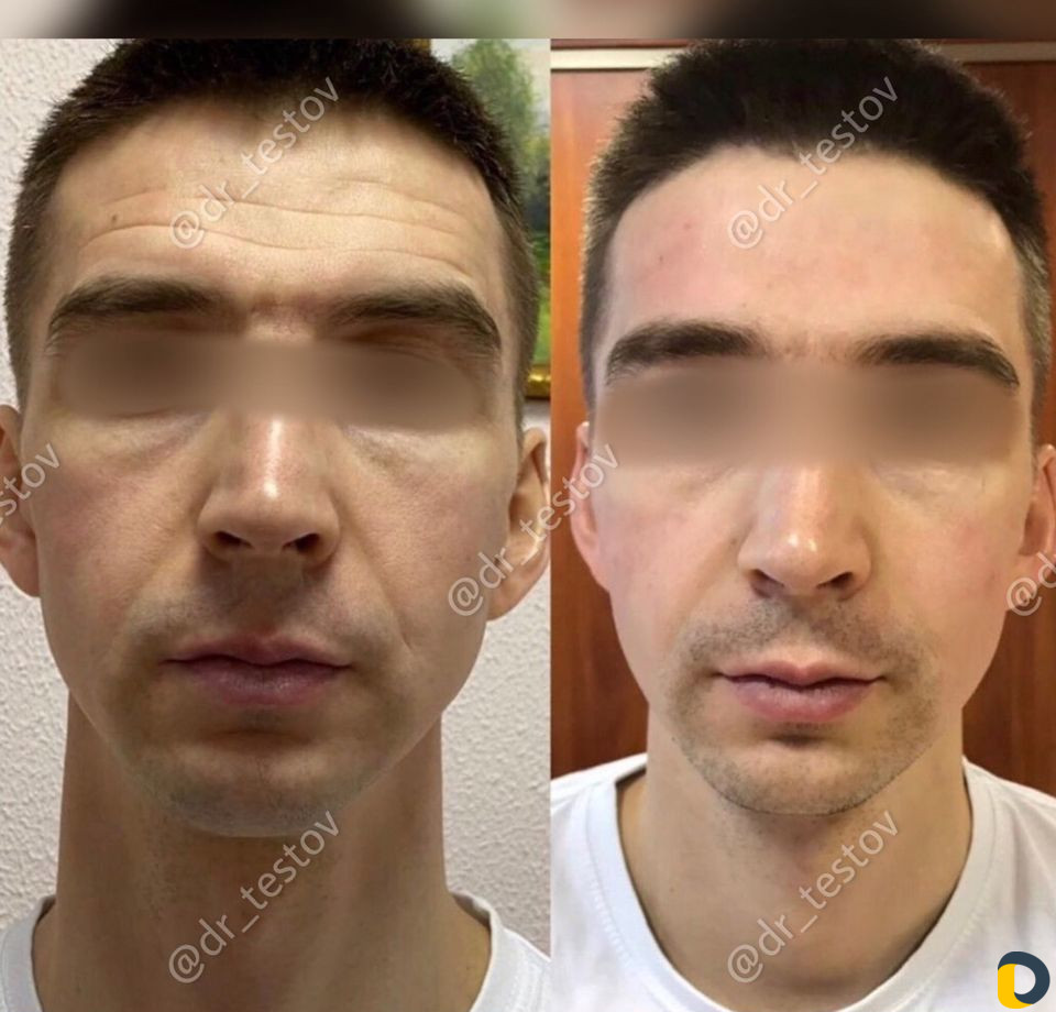 Фейслифтинг