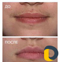 Фотоэпиляция на дому