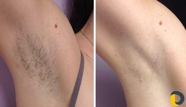 Фотоэпиляция на дому