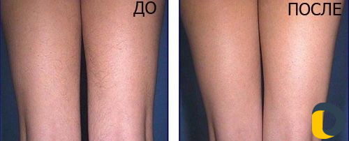 Фотоэпиляция на дому