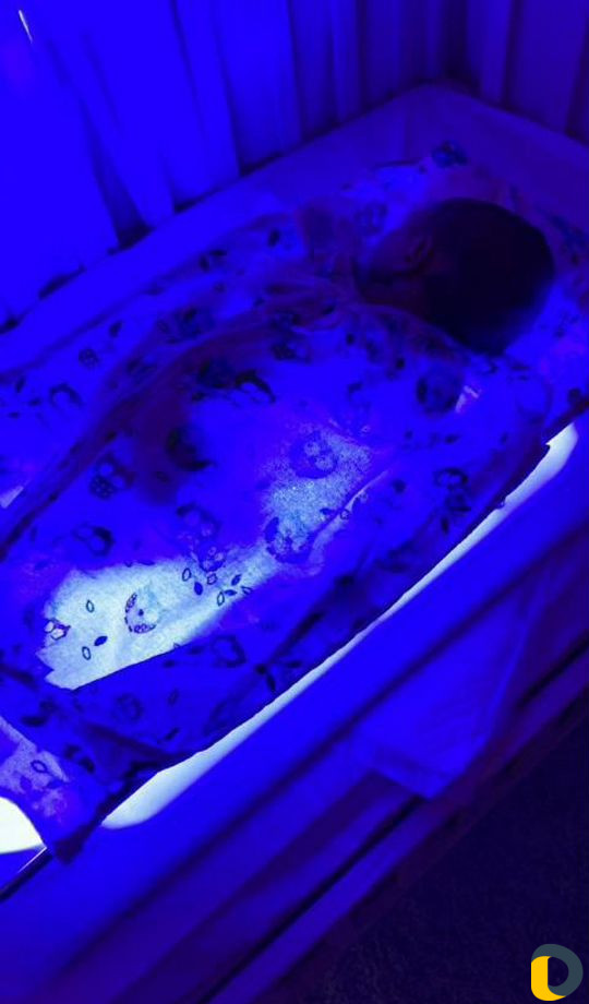 Фотолампа от желтухи в аренду +билитест