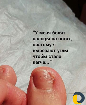 Исправление вросших ногтей