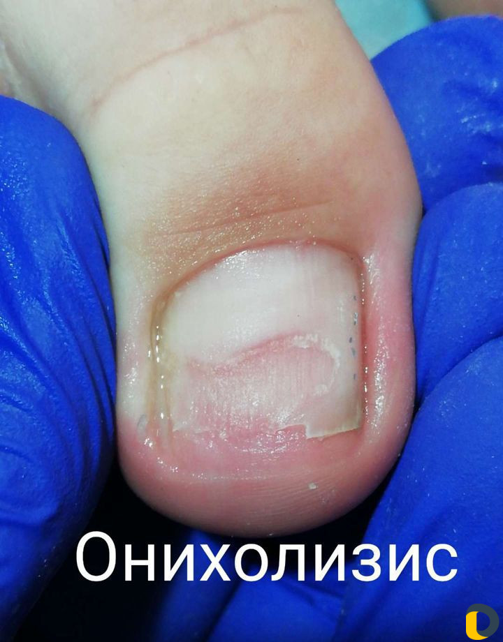 Исправление вросших ногтей