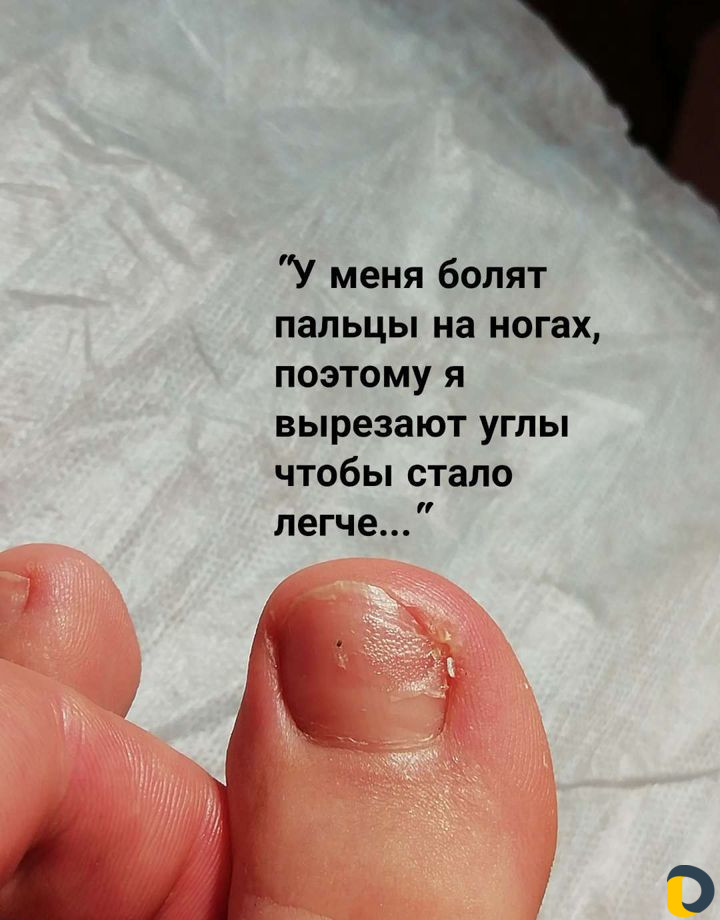 Исправление вросших ногтей