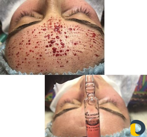 Капилляротерапия и Косметология