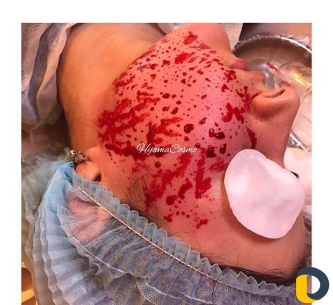 Капилляротерапия и Косметология