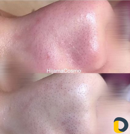 Капилляротерапия и Косметология