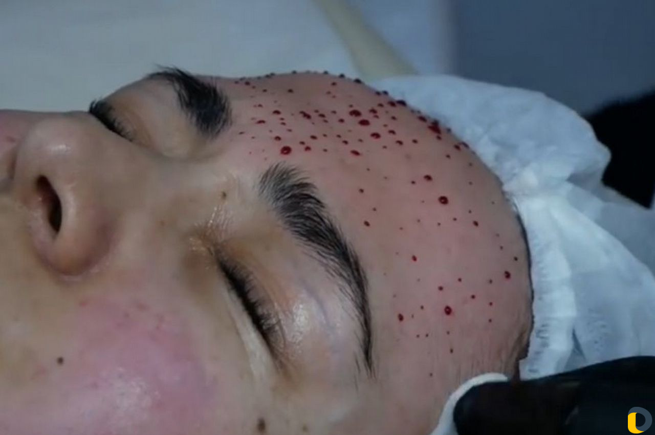 Капилляротерапия лица