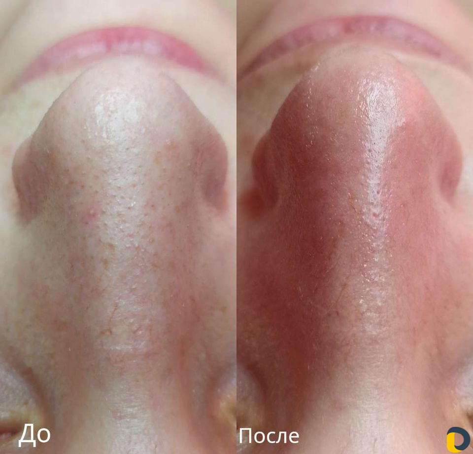 Комплексная чистка лица в 10 этапов