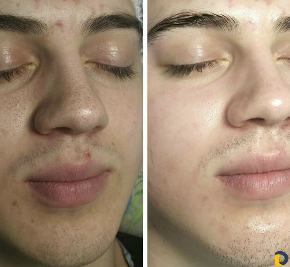 Комплексная процедура Чистка лица 3 в одном