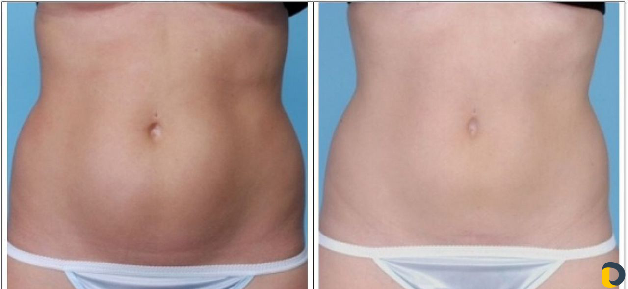 Коррекция фигуры, криолиполиз, LPG массаж Сочи