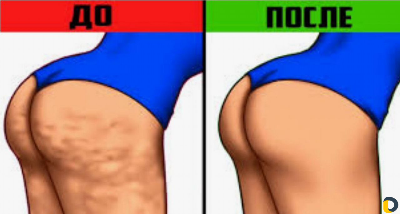 Коррекция фигуры, криолиполиз, LPG массаж Сочи