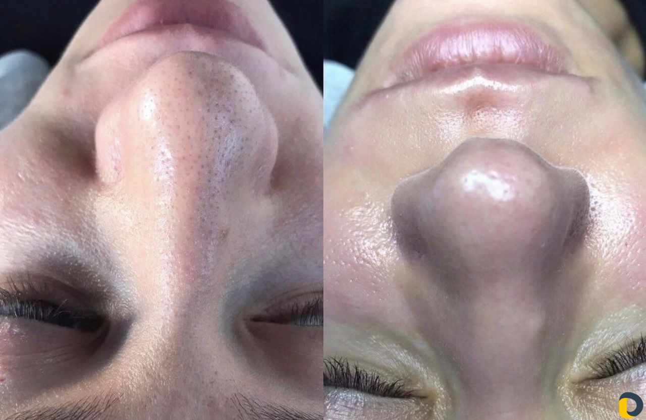 Косметолог чистка лица