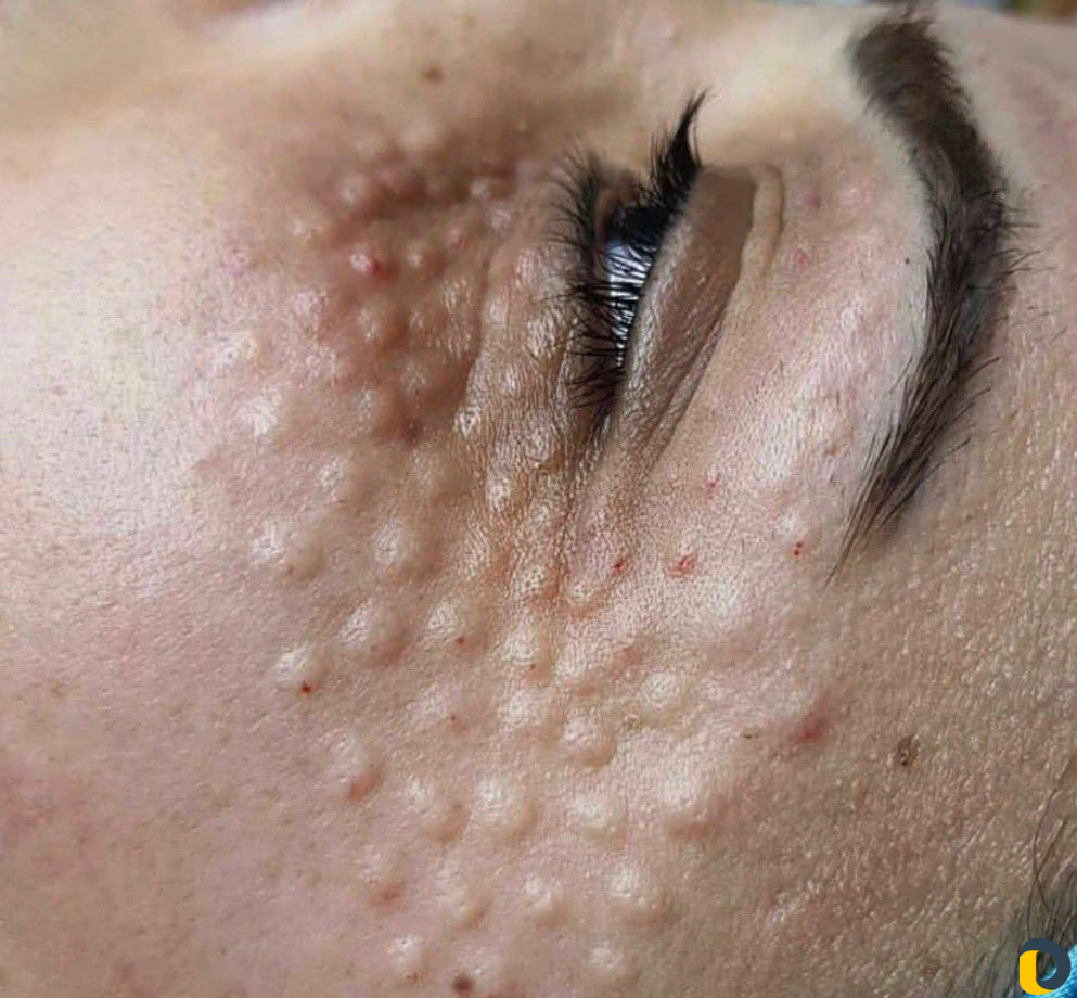 Косметолог чистка лица
