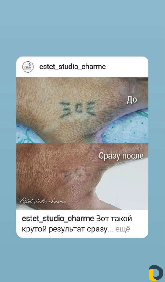 Косметологические процедуры. удаление татуировок