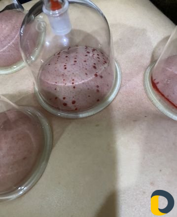 Кровопускание