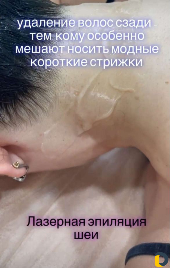 Лазерная эпиляция, удаление тату, RF омоложение