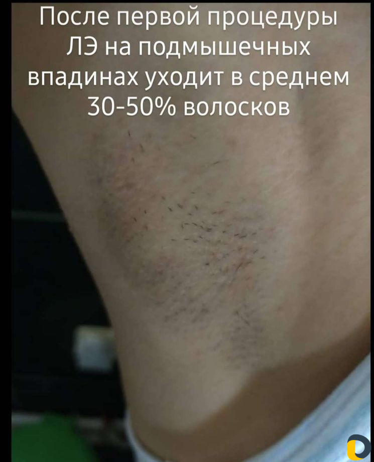 Лазерная эпиляция, удаление тату, RF омоложение