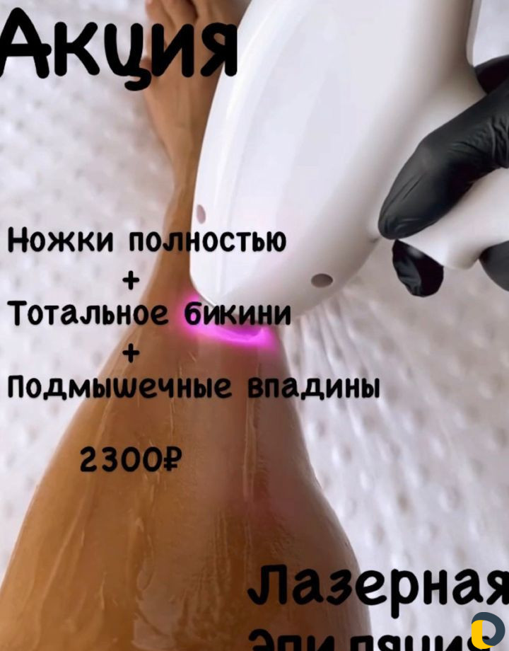 Лазерная эпиляция