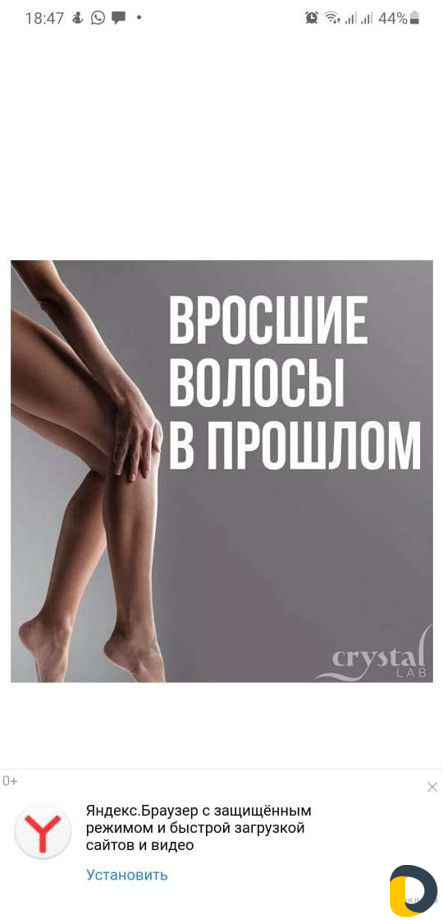 Лазерная эпиляция