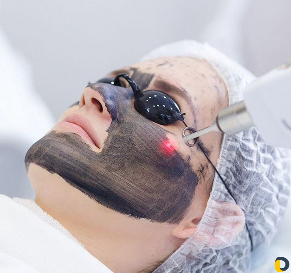 Лазерная эпиляция