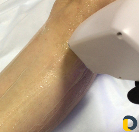 Лазерная Эпиляция