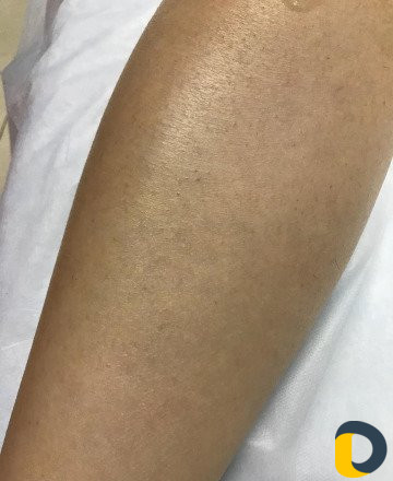 Лазерная Эпиляция