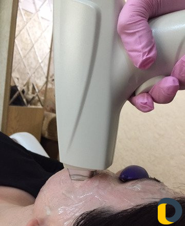 Лазерная эпиляция