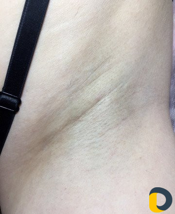 Лазерная эпиляция