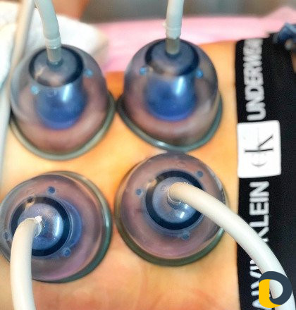 Лазерная эпиляция