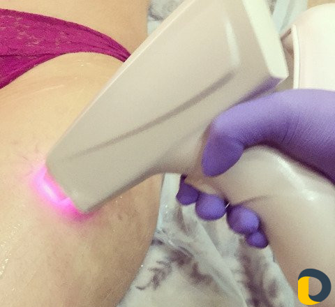 Лазерная эпиляция