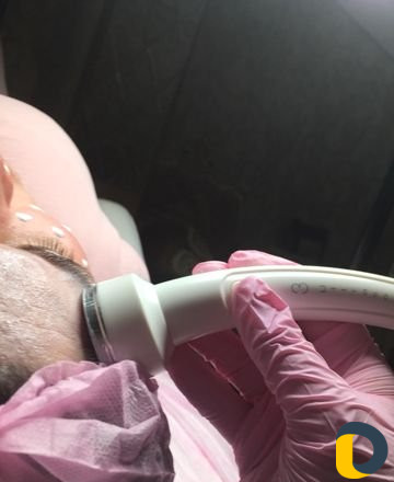 Лазерная эпиляция