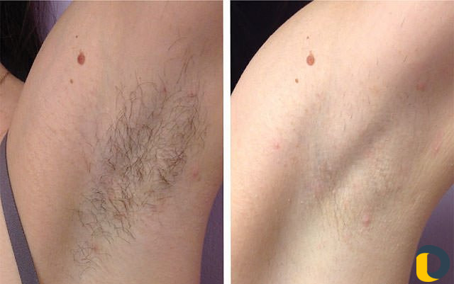Лазерная Эпиляция