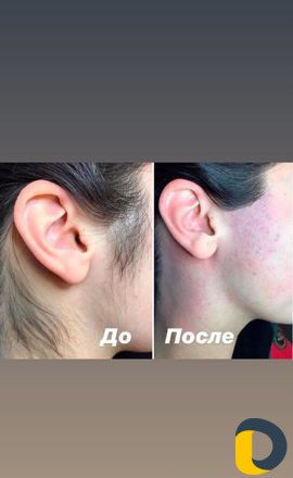 Лазерная эпиляция