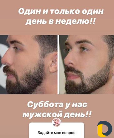 Лазерная эпиляция