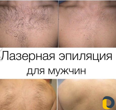 Лазерная эпиляция