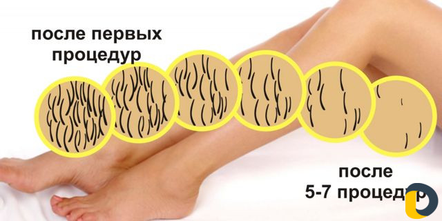 Лазерная эпиляция