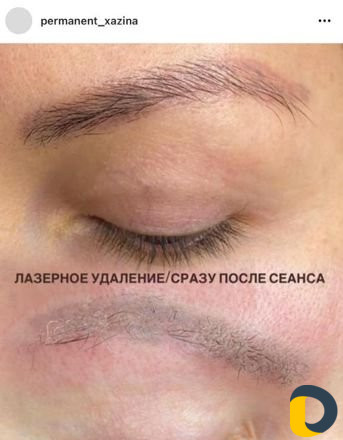 Лазерное удаление