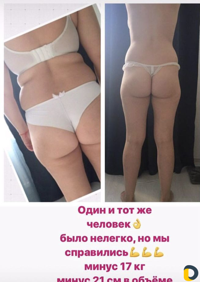 Массаж антицеллюлитный