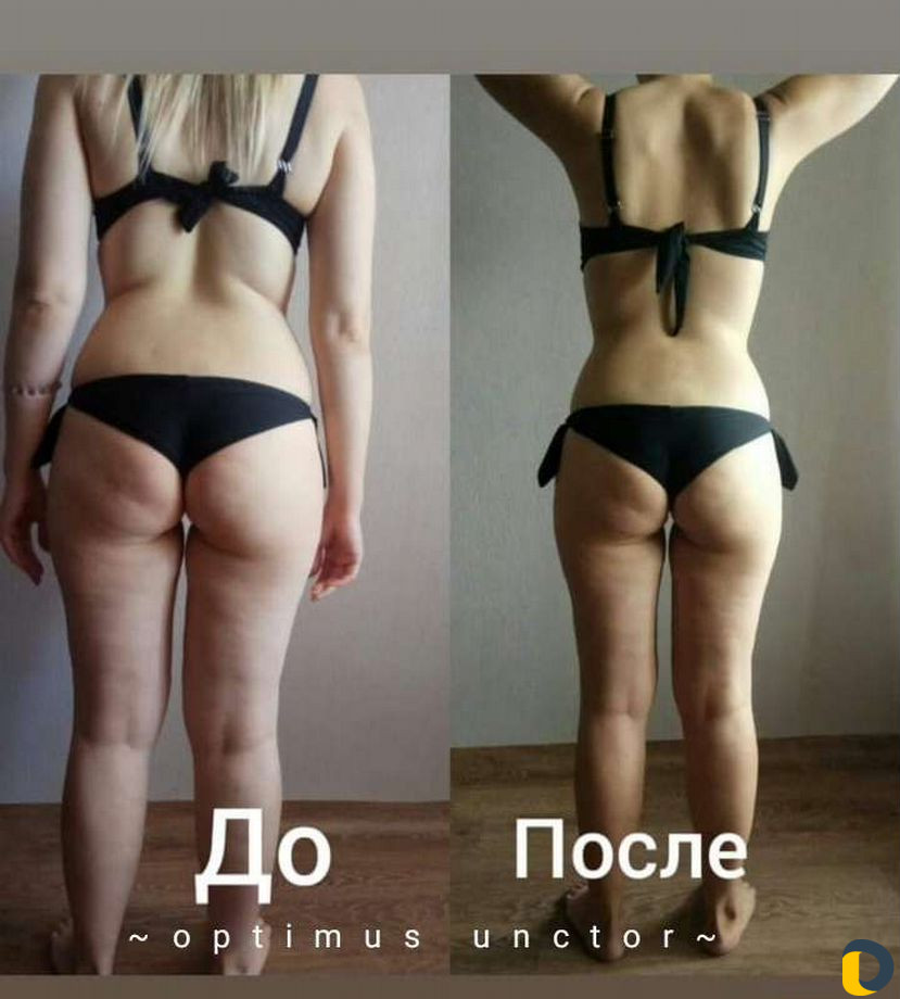 Массаж Антицеллюлитный