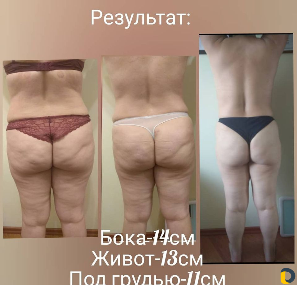 Массаж антицеллюлитный вакуумно роликовый баночный