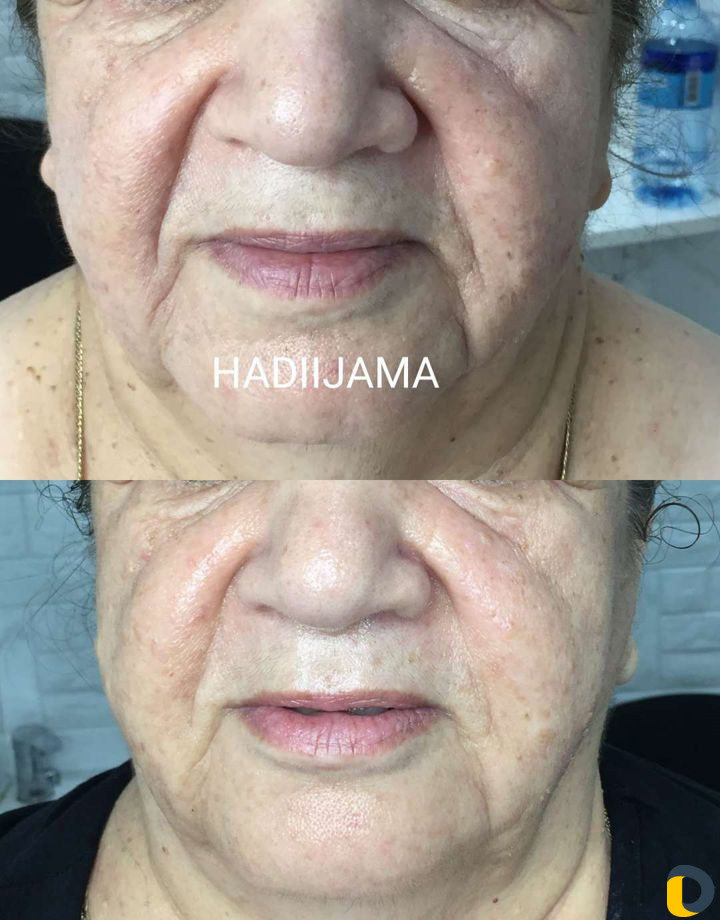 Массаж лица