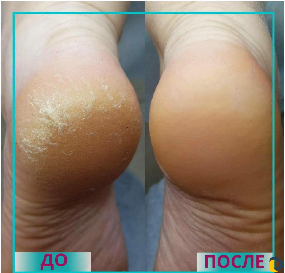 Медицинский педикюр