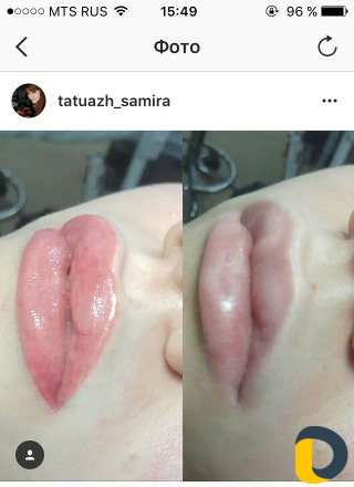 Микроблейдинг