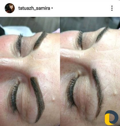 Микроблейдинг